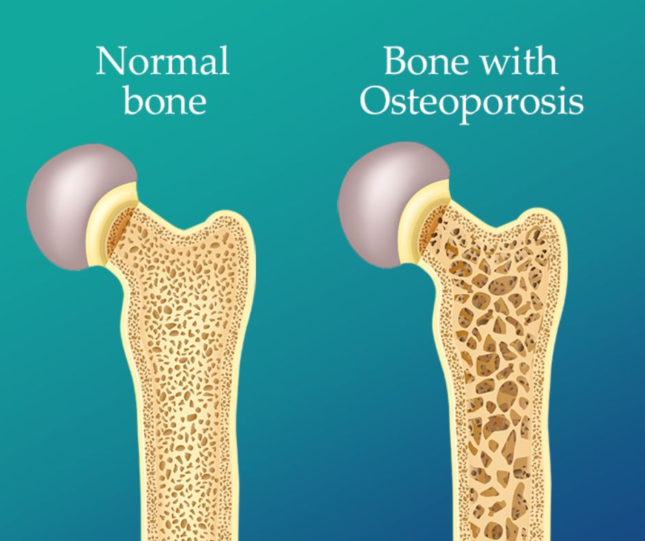 Bone Density-Bones